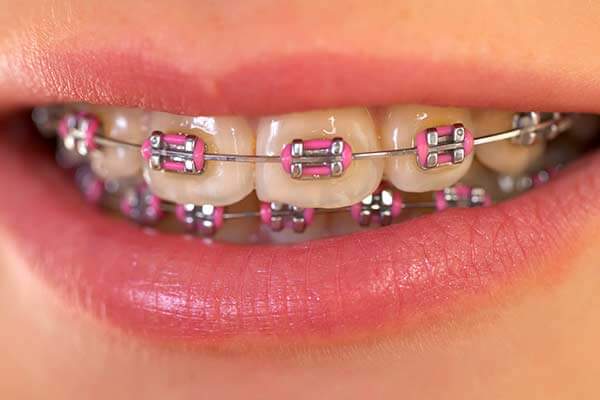 Smart Clip Self-Ligating Braces